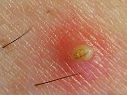 rambut tumbuh ke dalam nanah